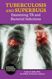 Tuberculosis and superbugs : examining TB and bacterial infections cover image cdn