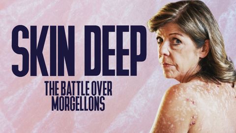 Skin Deep: The Battle Over Morgellons cover image cdn
