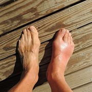 Gout Causes and Treatment cover image cdn