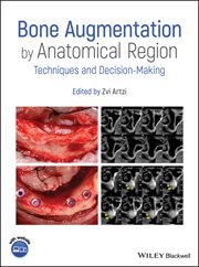 Bone Augmentation by Anatomical Region : Techniques and Decision-Making cover image cdn